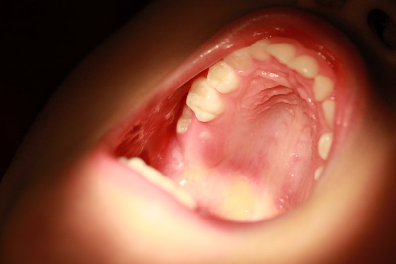 molar first