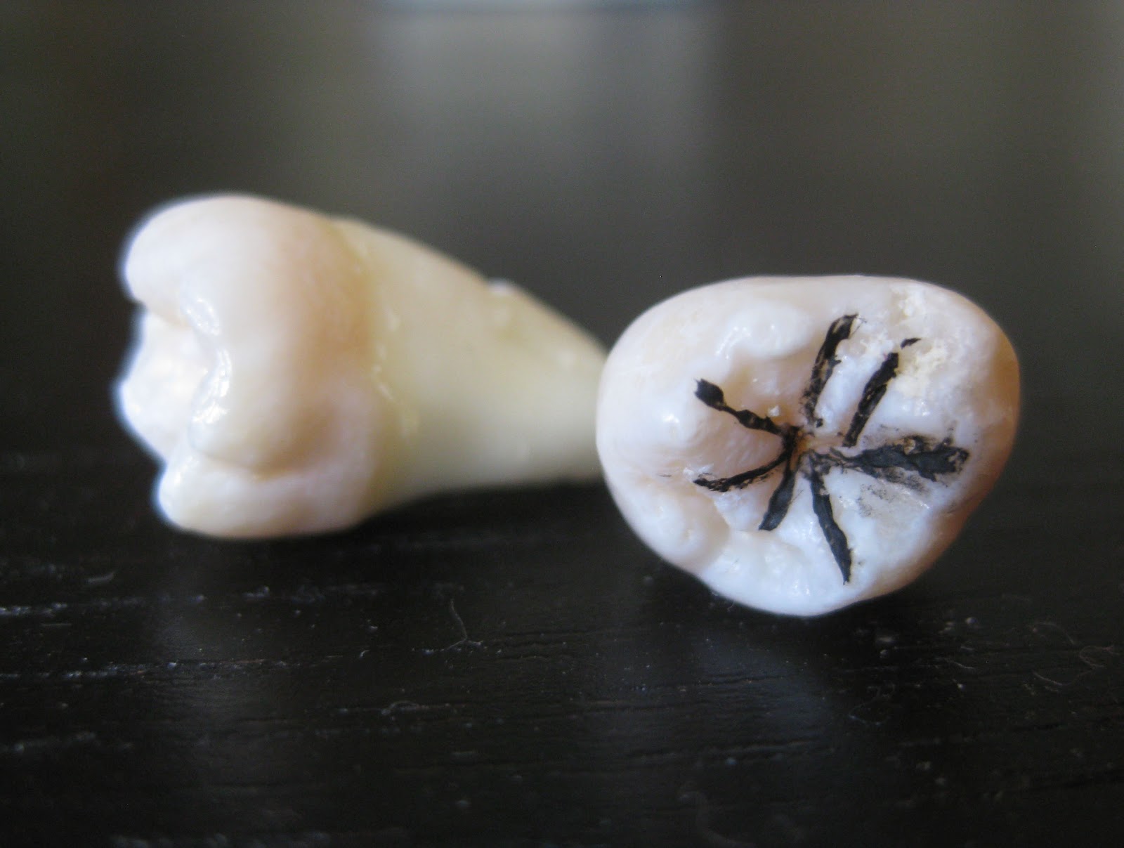 wisdom tooth