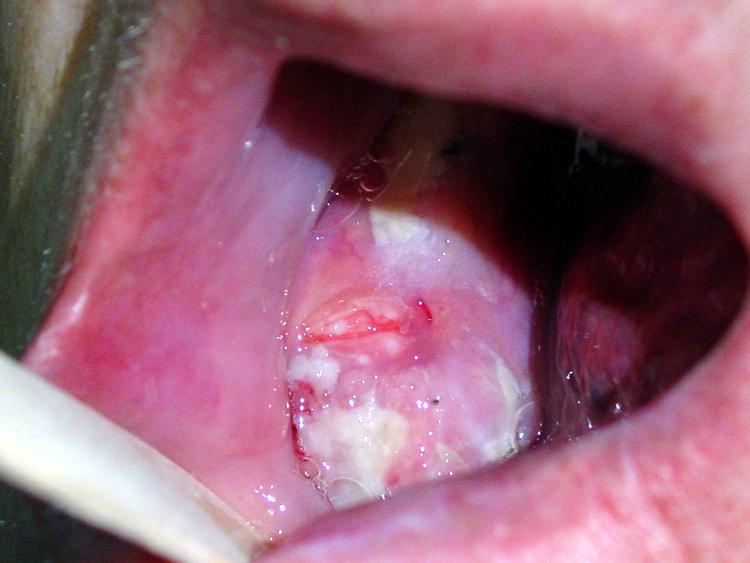 oral-cancer-3
