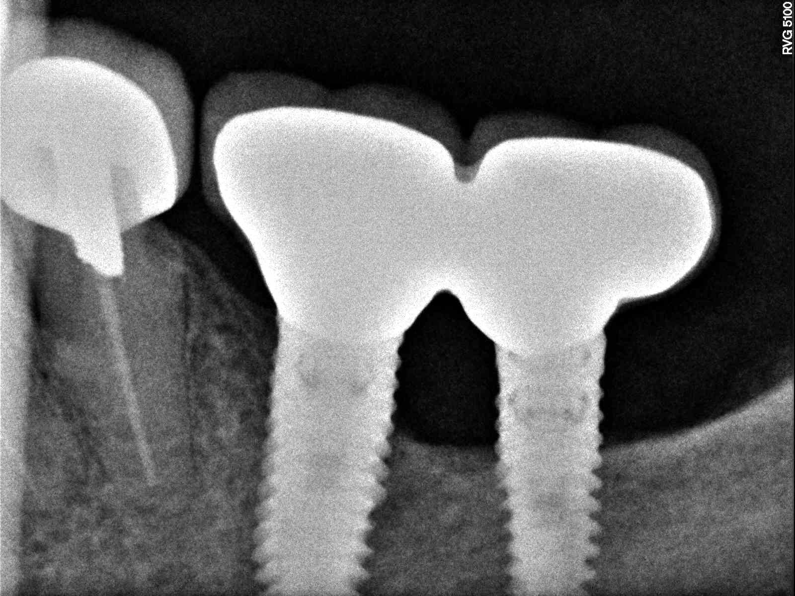 implant failure