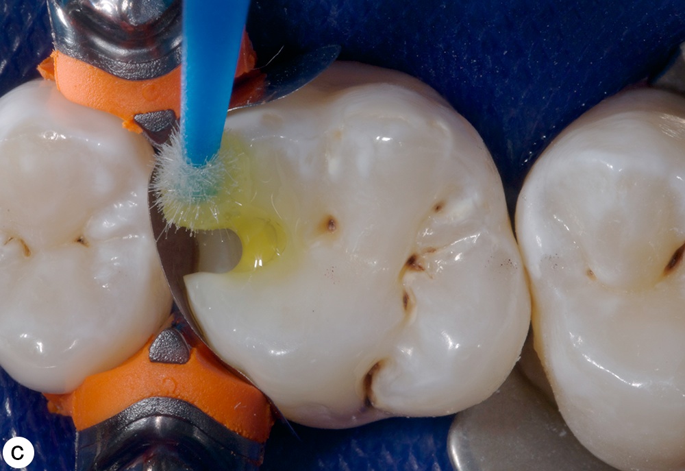 DENTAL BONDING AGENT