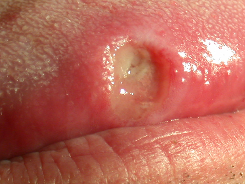 oral aphthous