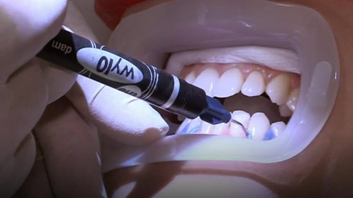 teeth whitening